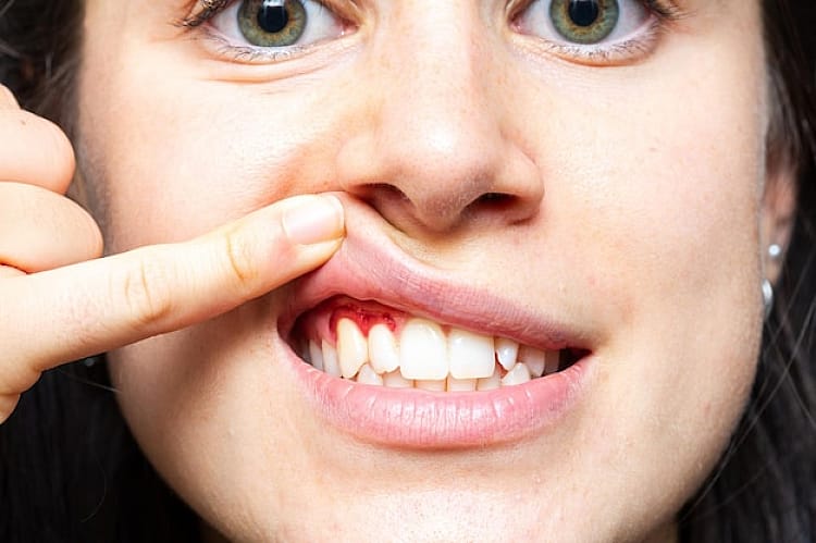 Wisdom Tooth Extraction Tooth Decay & Gum Infection