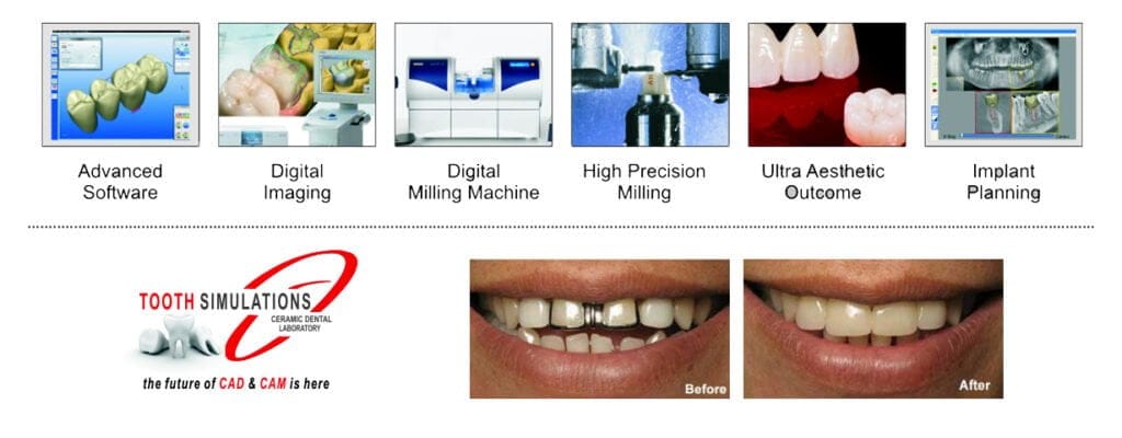 CAD CAM dental restorations in Hyderabad