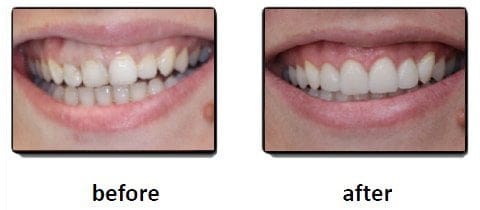 Professional Teeth Cleaning in Hyderabad