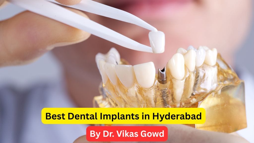 Best Dental Implants in Hyderabad – By Dr. Vikas Gowd Best dental implants in hyderabad
