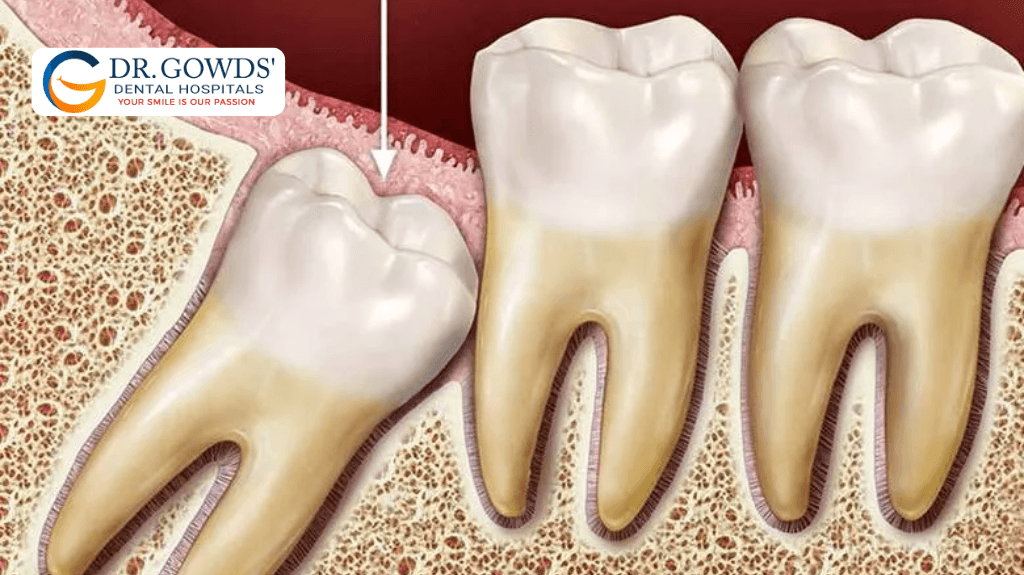 what are wisdom teeth and why do they need to be removed 