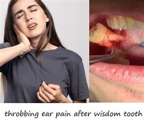 What Are Wisdom Teeth and Why Do They Need to Be Removed? image