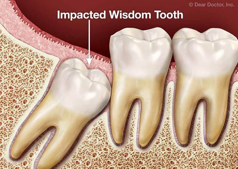 What Are Wisdom Teeth and Why Do They Need to Be Removed? image