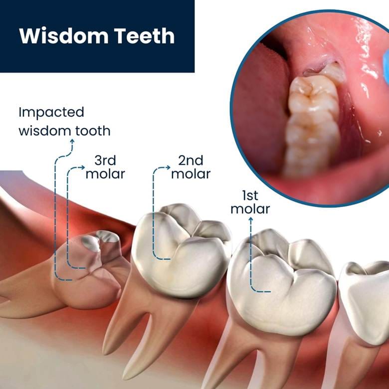 What Are Wisdom Teeth and Why Do They Need to Be Removed? image