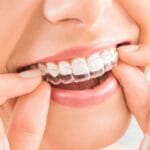 dental fact invisalign treatment is a quick and painless way to restore your misaligned teeth .jpg