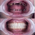 implante dentÁrio.jpg